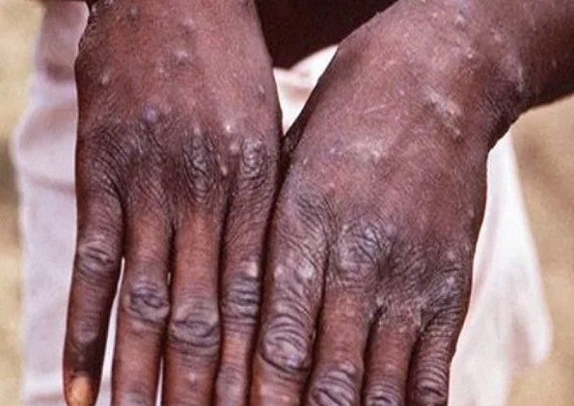 Monkeypox