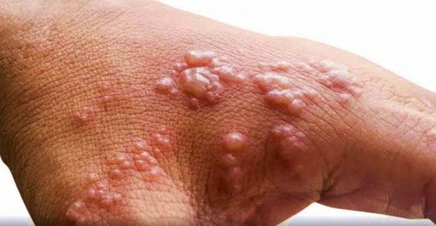 Monkeypox infection