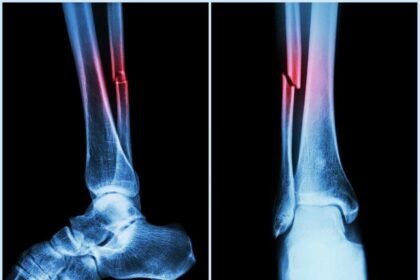 Covid Can Cause Bone Loss, Higher Fracture Risk