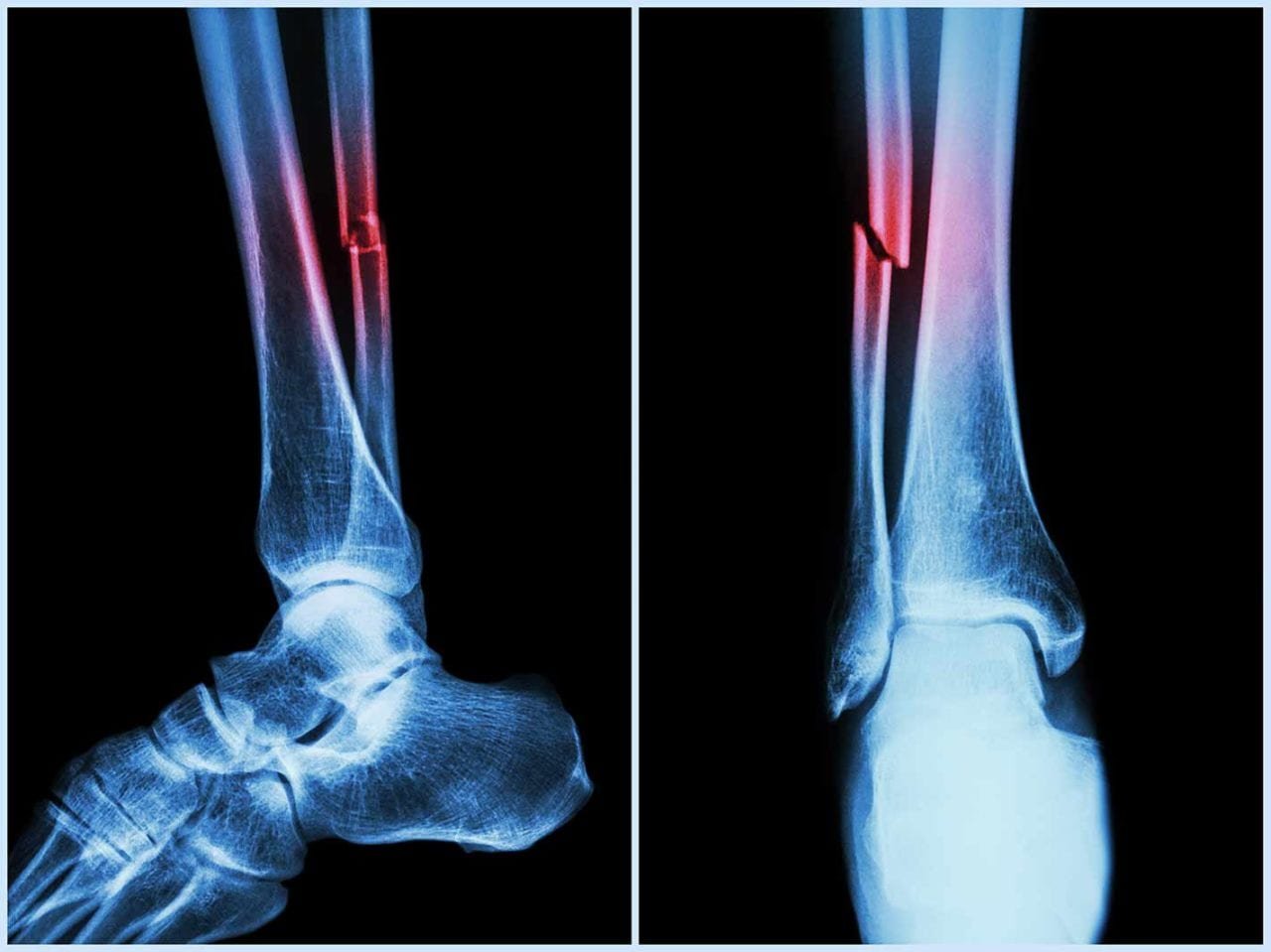Covid Can Cause Bone Loss, Higher Fracture Risk