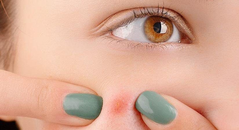 Pimples popping myths